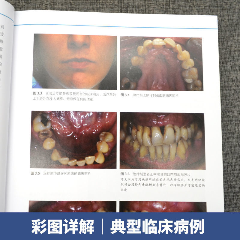 口腔精萃系列--口腔種植工藝操作流程：分步驟操作指南